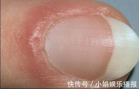 黄甲综合征|身体有问题,指甲告诉你!指甲出现9种变化,恐是疾病来袭