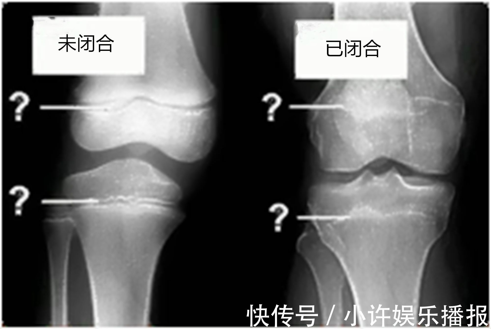 孩子|三种信号提示孩子骨骼线即将闭合，父母及时发现，及时补救很重要