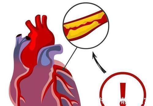 心脑血管疾病|甘油三酯这么降最快，3个月从62降到15，高血脂不攻自破