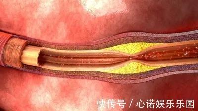 心血管|心脏病做什么检查最准?心血管医生告诉你