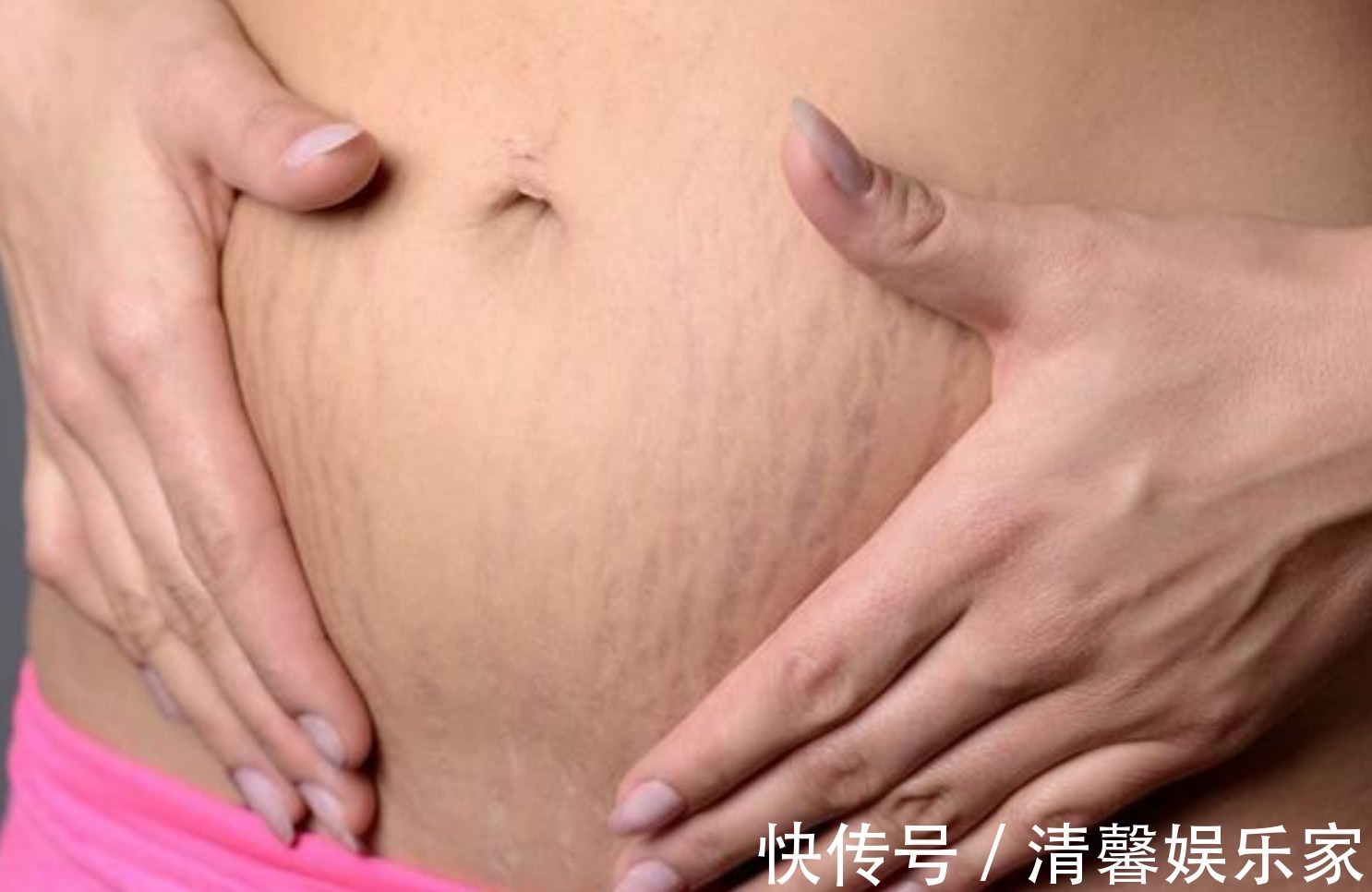 肚皮|孕期妊娠纹“找上门”，体重控好锻炼不能少，坚持守住三原则
