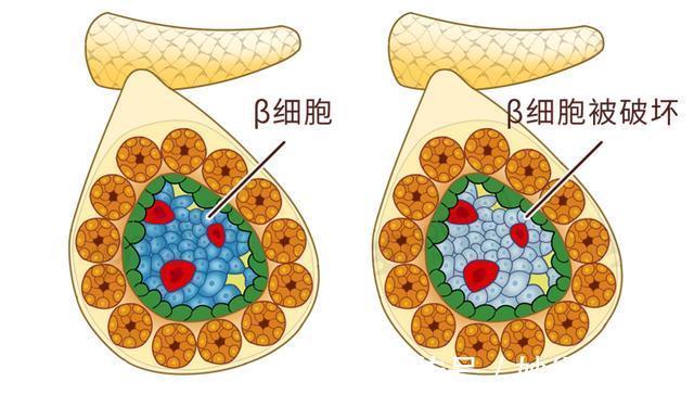 抗氧化物|不吃碳水化合物，就能逆转90%的2型糖尿病？终于有医院说实话了