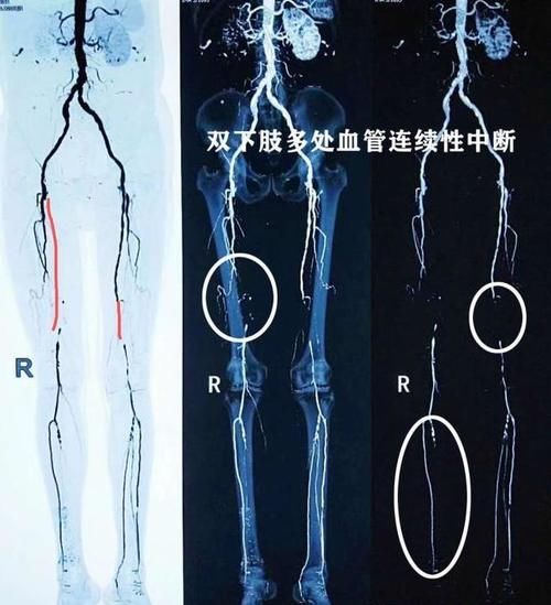 糖尿病人，经常腿疼是什么原因？