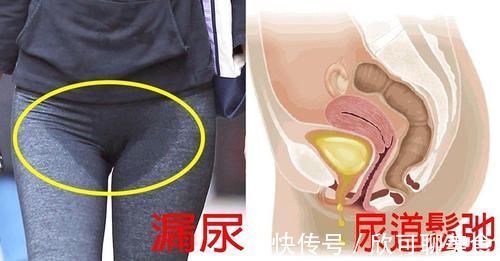 子宫破裂|“顺产再好,我也不选”,95后孕妈给出的理由,让人很难反驳