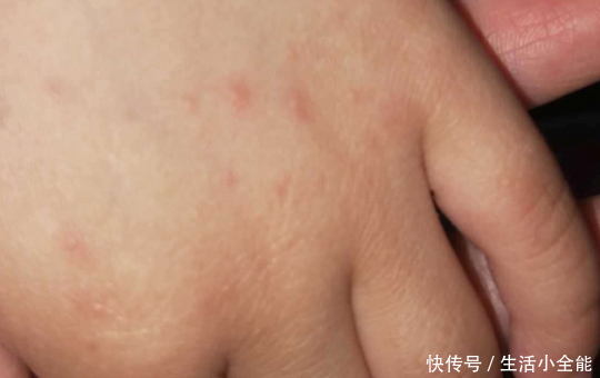 小痘痘|小孩手上起小米粒疙瘩很痒!一定要注意!
