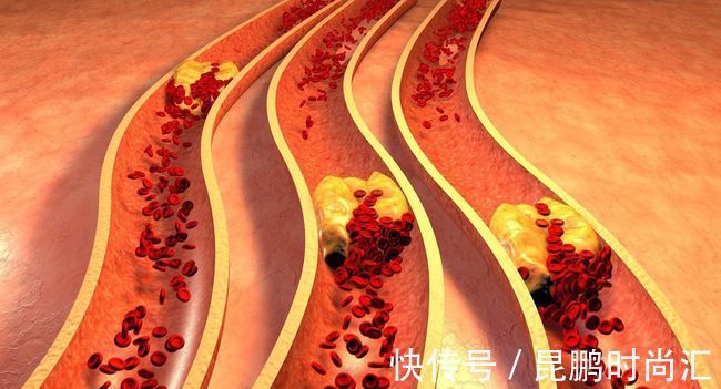 血管|血脂高,应远离豆腐?坦白说:除了豆腐,5种“素食”还请少吃点