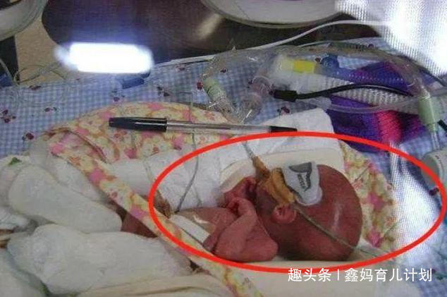 营养物质|14年过去了,那个出生体重仅0.56斤的世界最小婴儿,现如今怎样了