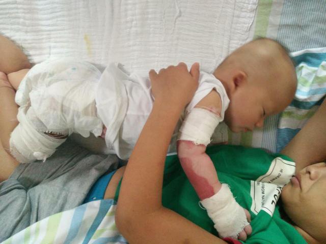 家长|孩子被烫伤后,是先脱衣服还是先冲冷水家长一定要提前知道