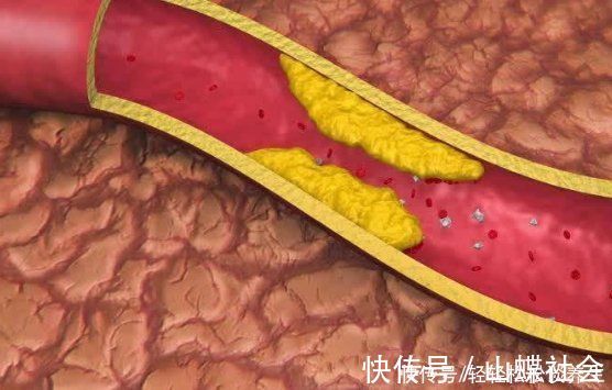 血液粘稠|高血脂害怕2件事，不是山楂，你若能堅持做，血管垃圾一掃而空
