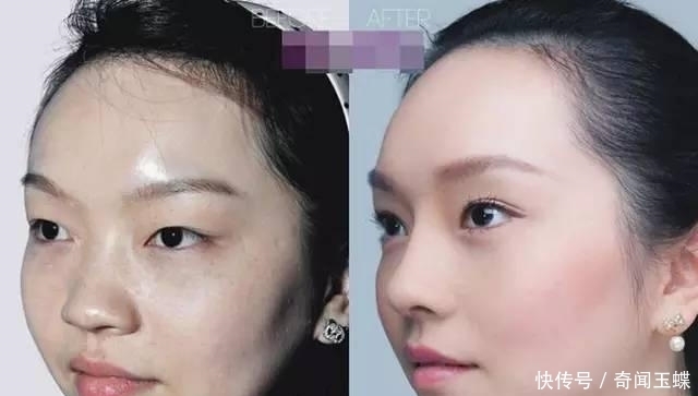双眼皮|实拍:10张女孩整容前后的对比照,这真就是换了一张脸