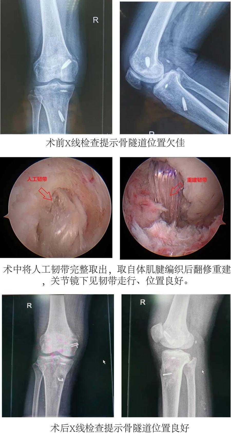 重建|韧带术后仍疼痛，翻修手术除病痛