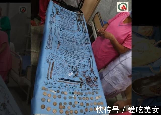 珠宝|印度一女子身体里竟取出价值45万的珠宝:69条链子,80个耳环