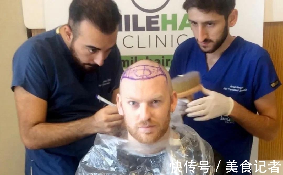 chris 每个月到底有多少人去土耳其植发？