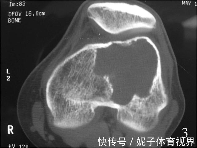 患者|膝盖疼，就是得滑膜炎了？医生辟谣，教您一步步判断自己的病因