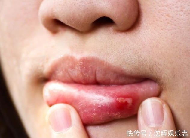 西瓜霜|口腔溃疡虽是小小一个，但却疼痛难忍，一类野草一抹，第二天就好