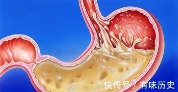 三防线|守住三条线癌症无法上身，那么抗癌三防线是哪三条线？