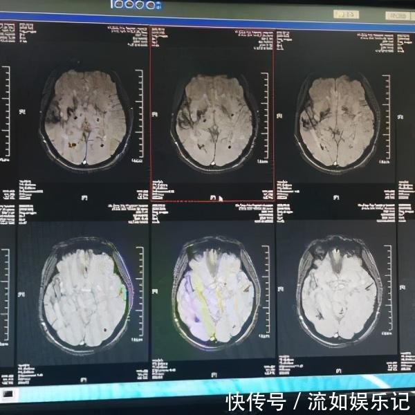 头晕头痛|53岁大妈1年脑出血3次,医生怒斥:人老了,4件事还不控制好