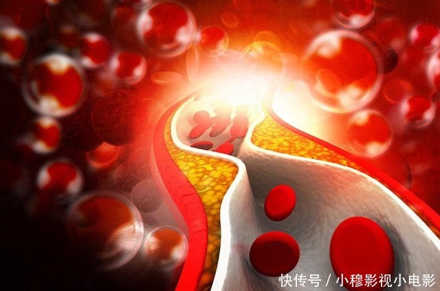 医生|多走路可以降血脂?心血管医生:过了50岁,做好3件事或更有效