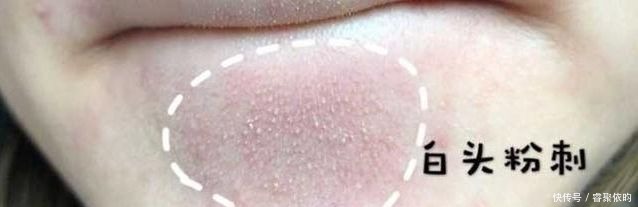 水杨酸|闭口、黑头、痘痘、脂肪粒……终于分清它们是什么了