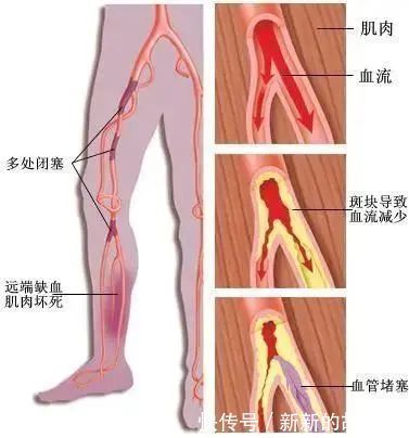 动脉硬化|腿部出现这种症状,有可能是下肢“中风”!