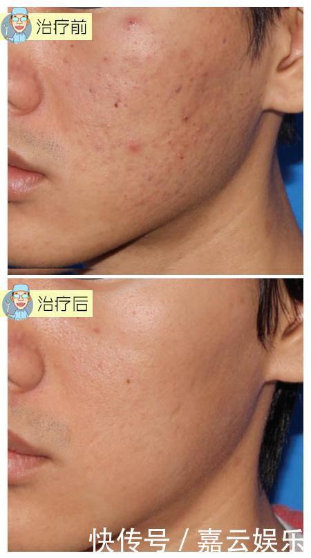 收敛毛孔，除了光子嫩肤，这两种方法也很出色