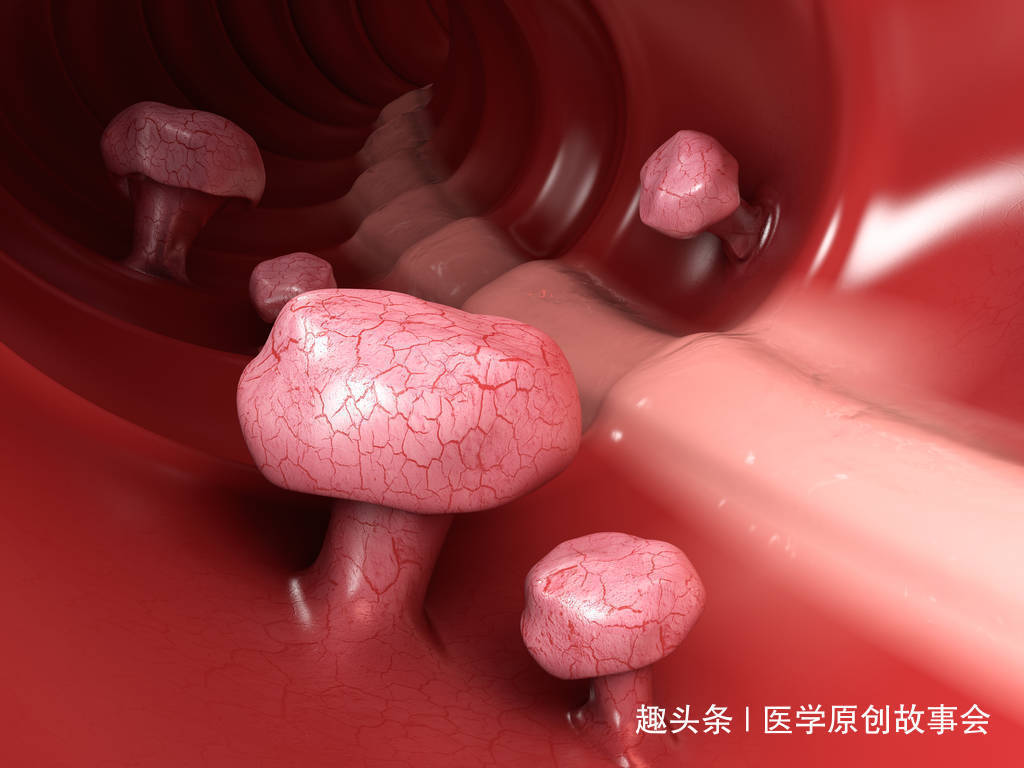 肠镜检查|三种息肉一旦发现,最好及时切除,一拖再拖会变成恶性肿瘤