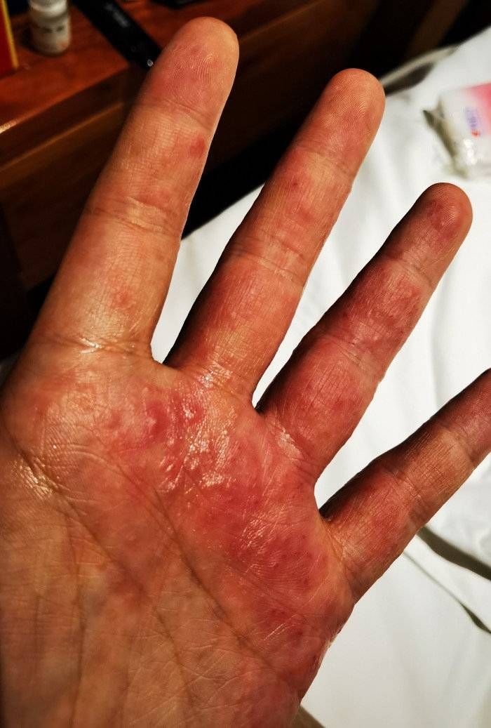 李峥|抗疫志愿者的手你见过吗？长期戴两双手套捂出满手湿疹