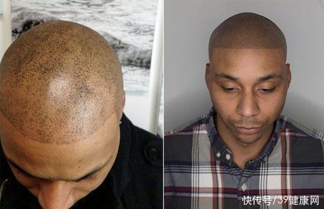 移植|揭秘植发全过程:一次植发能维持多久?哪些人不适合做?有多贵?