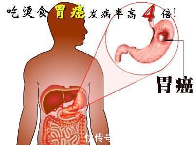 胃镜检查|胃开始癌变,身体会出现“3多2臭”,若1个没占,胃部还算健康