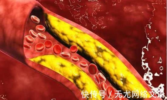 克星|高血脂“克星”公开，避免做这几件事，血管干净通畅