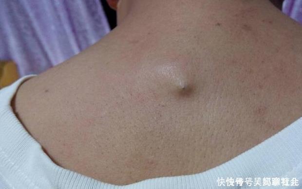 痘痘|后背痒抠下小颗粒,后背沦为螨虫“江山”,2洗1吃,螨虫将蹭蹭掉