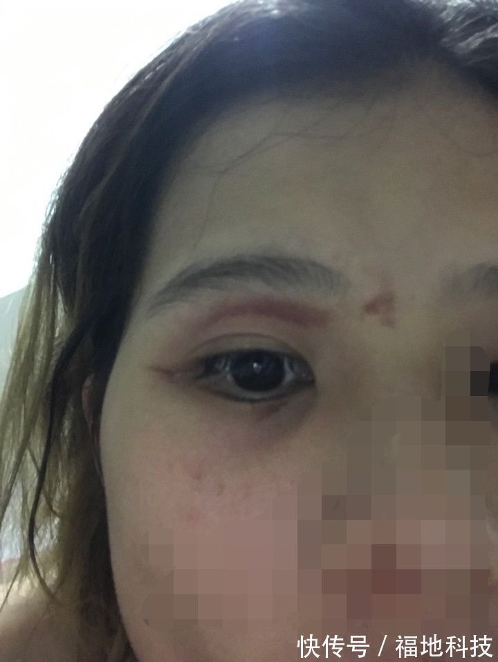 男孩|6岁男孩只因惹了这个小家伙脸部皮肤溃烂。麻烦就在“举手之间”