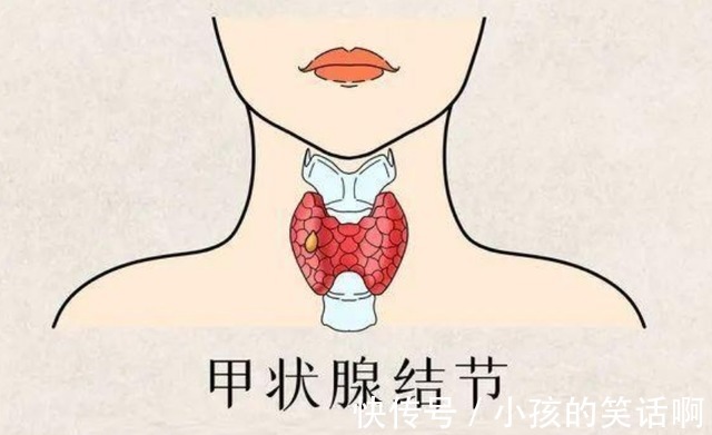 辛辣刺激|甲状腺有结节?饮食不能太放肆,牢记“2吃2不吃”或有助结节消散