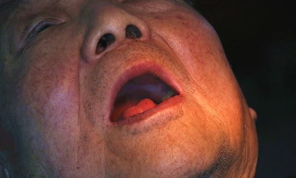 槟榔碱|口腔癌是怎么回事医生坦言一旦出现3个信号,尽快做检查