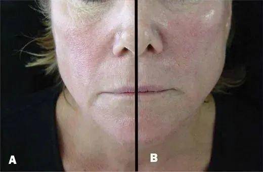 真皮层 热玛吉做完之后皮肤会不会加速衰老?不同年龄段做了热玛吉都会有什么改变?