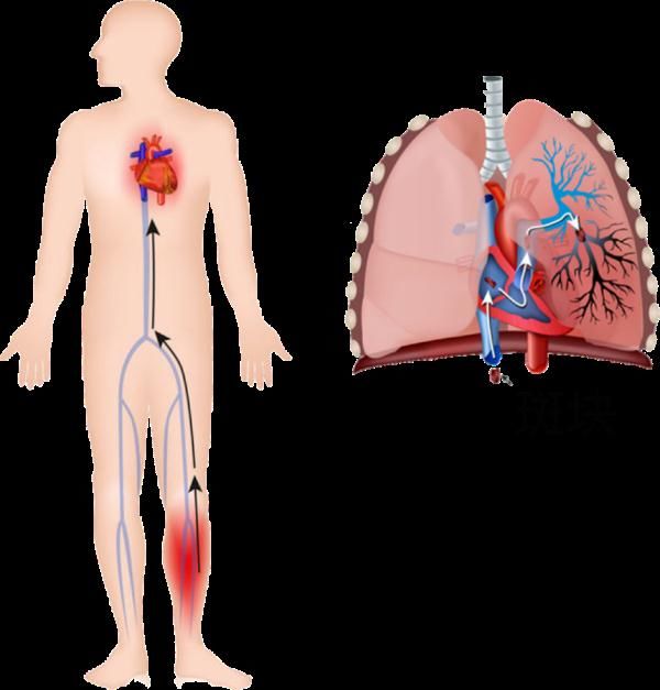 肺栓塞|它是心梗、脑梗的元凶，更容易找上这些人