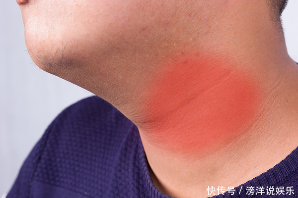 甲状腺结节患者,不妨常吃三物,或能化瘀散结,恢复甲状腺健康