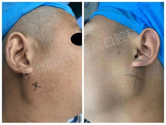 肿瘤|注意！耳朵下这块不痛不痒的鼓包，可能是腮腺肿瘤