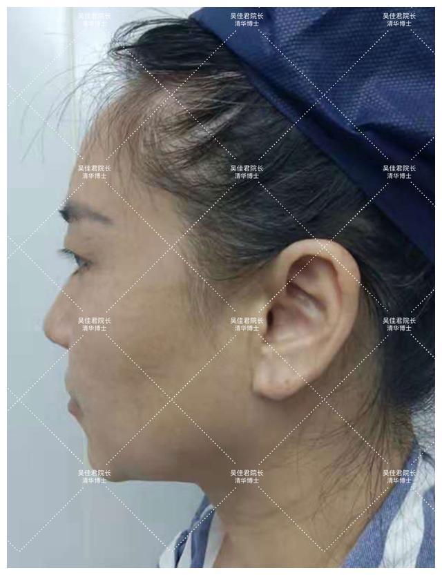 面部 51岁小拉皮术后1个月,我想跟大家说点真心话