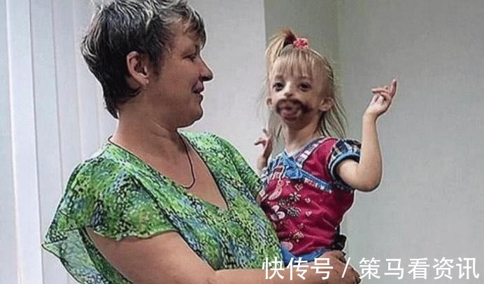 夫妻二人|三岁小女孩患“罕见怪病”,一出生就没有嘴巴,医生建议安乐死