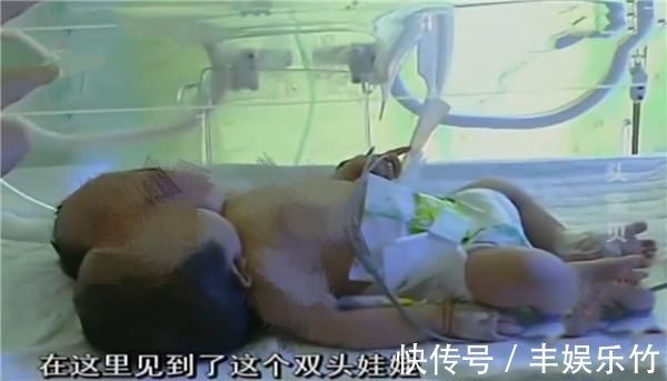 孩子|孕妇生下罕见“双头婴”，众人都来围观，专家的话却令人担忧