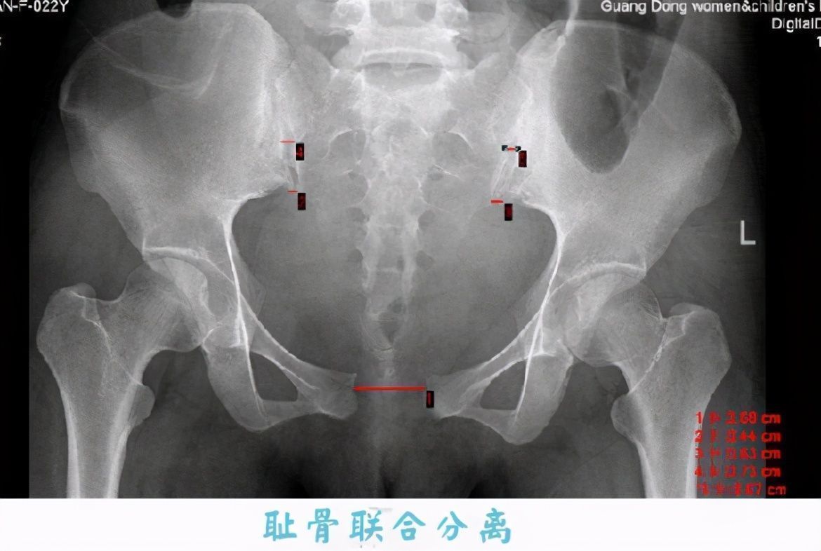 疼痛|“耻骨痛到厌世”，为何孕期会耻骨痛？原来是两块骨头在分离