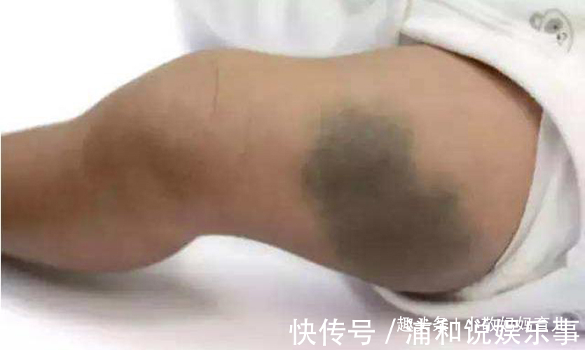 产科医生|胎记是怎么来的?妇科医生:除了遗传,孕期尽量避开这3种行为