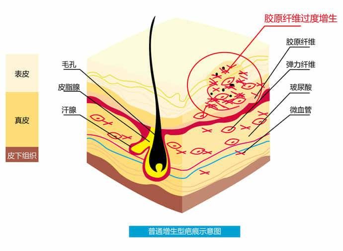 伤口愈合|同样是受伤，同样很好愈合，为什么别人只留下了印，我却留了疤？