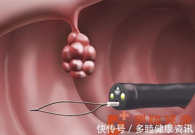 恶变率|日本体检-息肉、肿块会癌变吗？体检发现这几个地方要尽快切除！