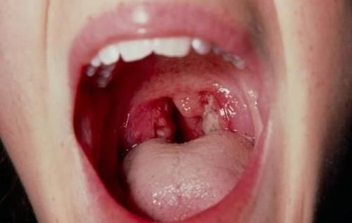 扁桃体结石是如何形成的 扁桃体结石有哪些症状 快资讯 扁桃体结石是如何形成的 扁桃体结石有哪些症状 快资讯