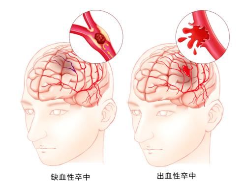 中风太可怕！知道这个时间窗，能救命降残……