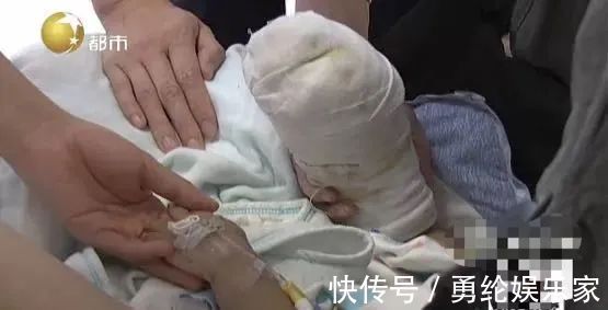 总医院|17个月大宝宝被严重烫伤！奶奶第一时间一个举动，雪上加霜