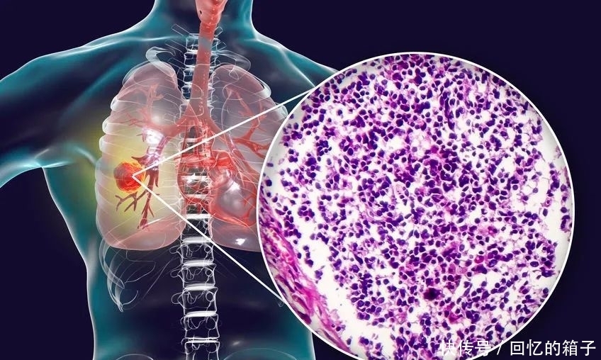 肺癌早期静悄悄?发现早期肺癌,这个方法一定要知道