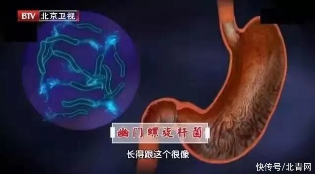 胃食管反流|胃病无小事，一不小心可能拖成癌！有这些迹象要及时就诊